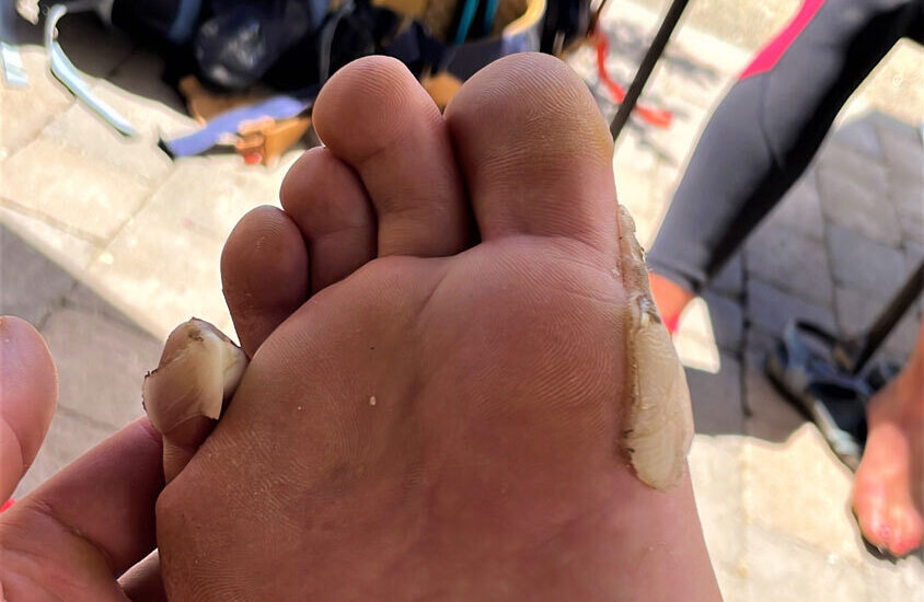 Foot blister plasters not working